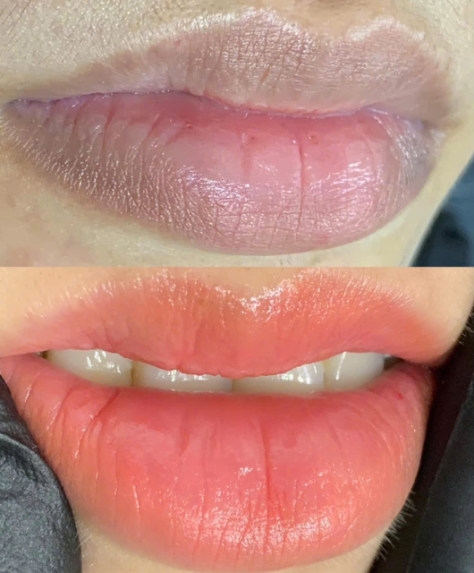 Khử Thâm Môi Nam - Nữ 